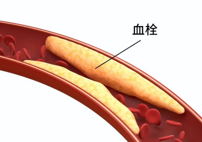 脑梗预警数据揭秘:95%的患者忽视了这4个关键异常信号 健康养生